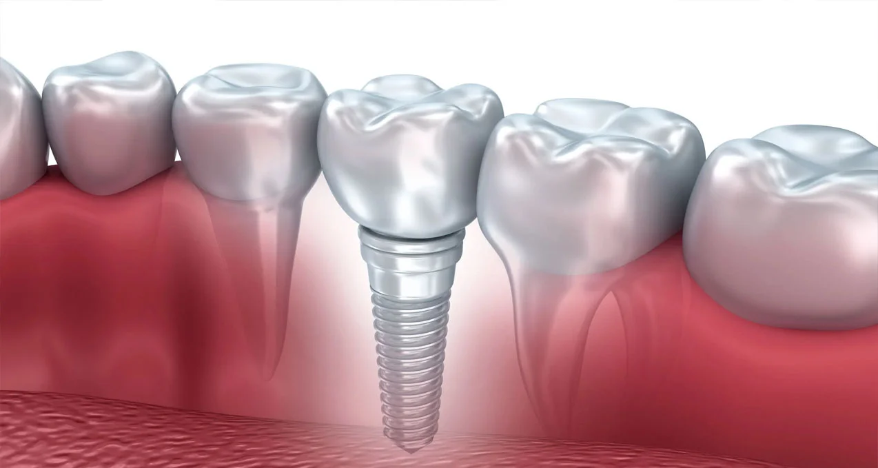 İmplant Diş Çok Can Acıtır Mı
