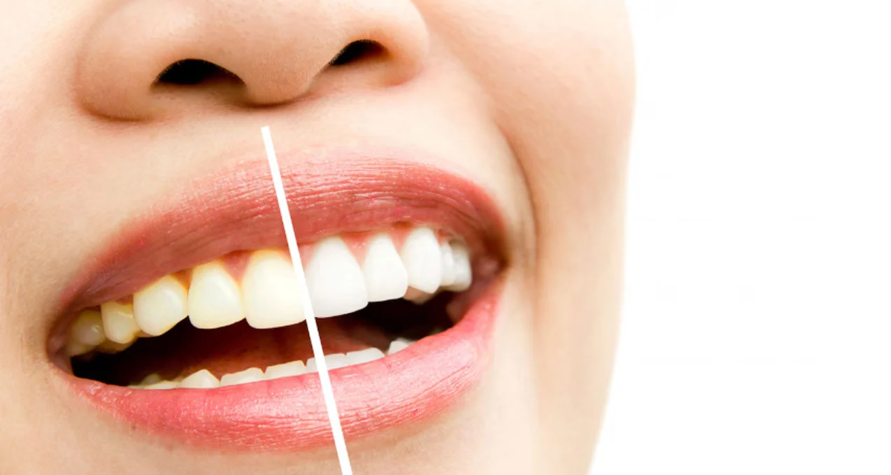 Lamine Diş Kaplama Fiyatı 2025